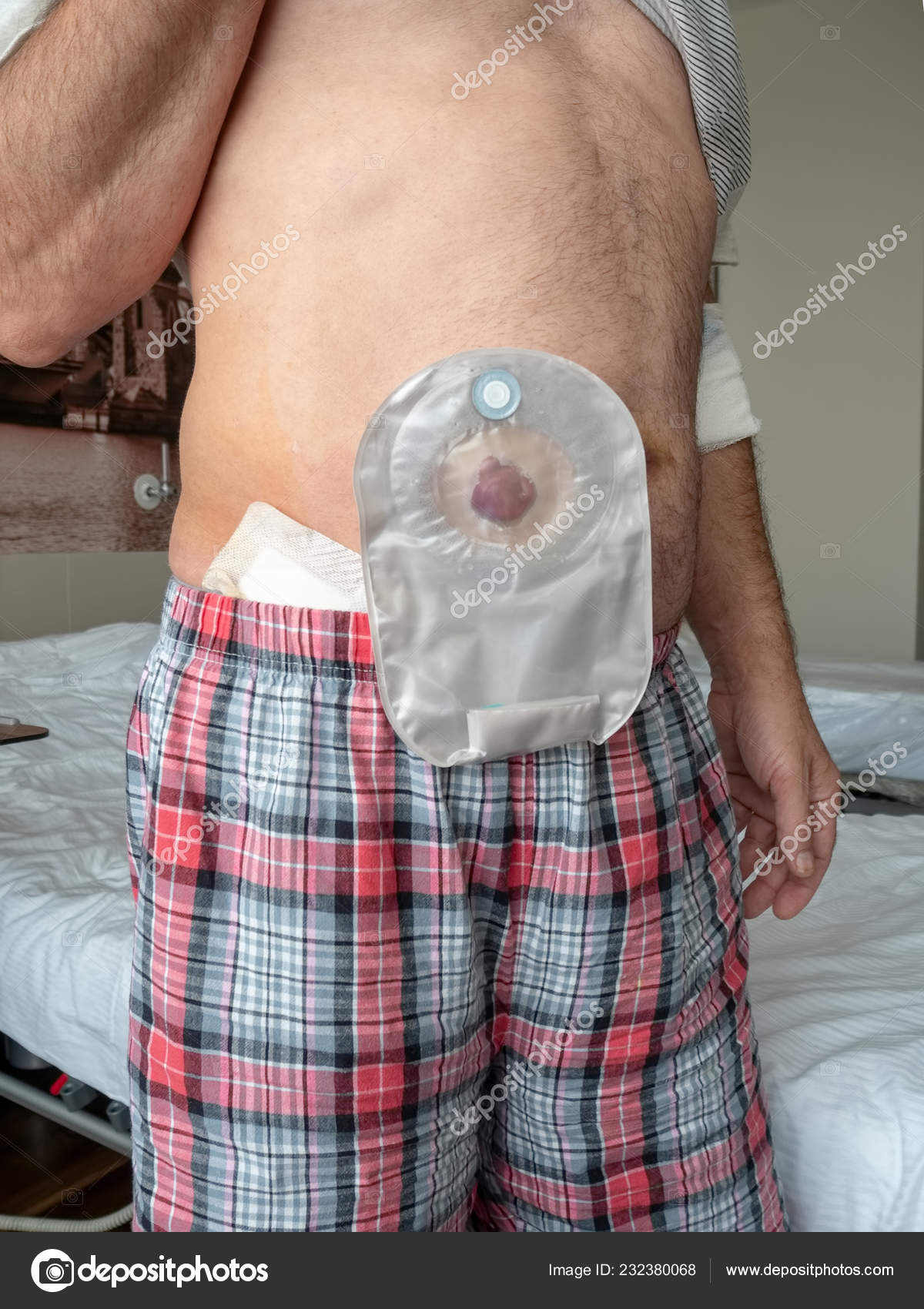 Voorbeeld van ileostoma